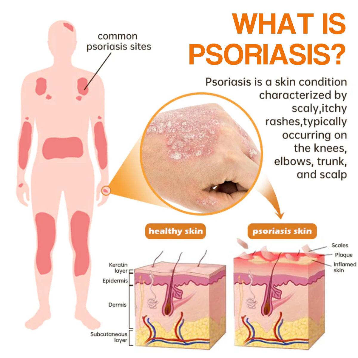 ✨【 official Brand Store】 Last Day Discount: 83% OFF 🌸 LOVILDS™ PsoriaHeal psoriasis Spray pro