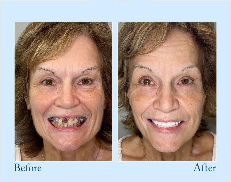 NESLEMY™-Advanced Full Denture Set (⏰Limited time discount last 30 minutes⏰)