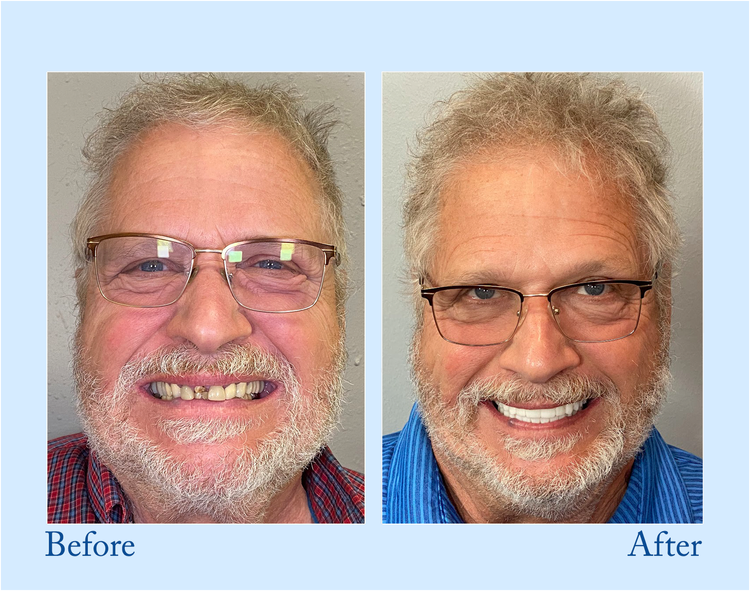 NESLEMY™-Advanced Full Denture Set (⏰Limited time discount last 30 minutes⏰)