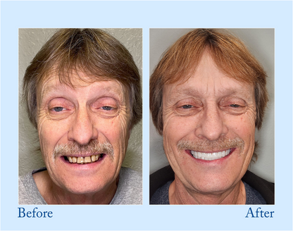 NESLEMY™-Advanced Full Denture Set (⏰Limited time discount last 30 minutes⏰)